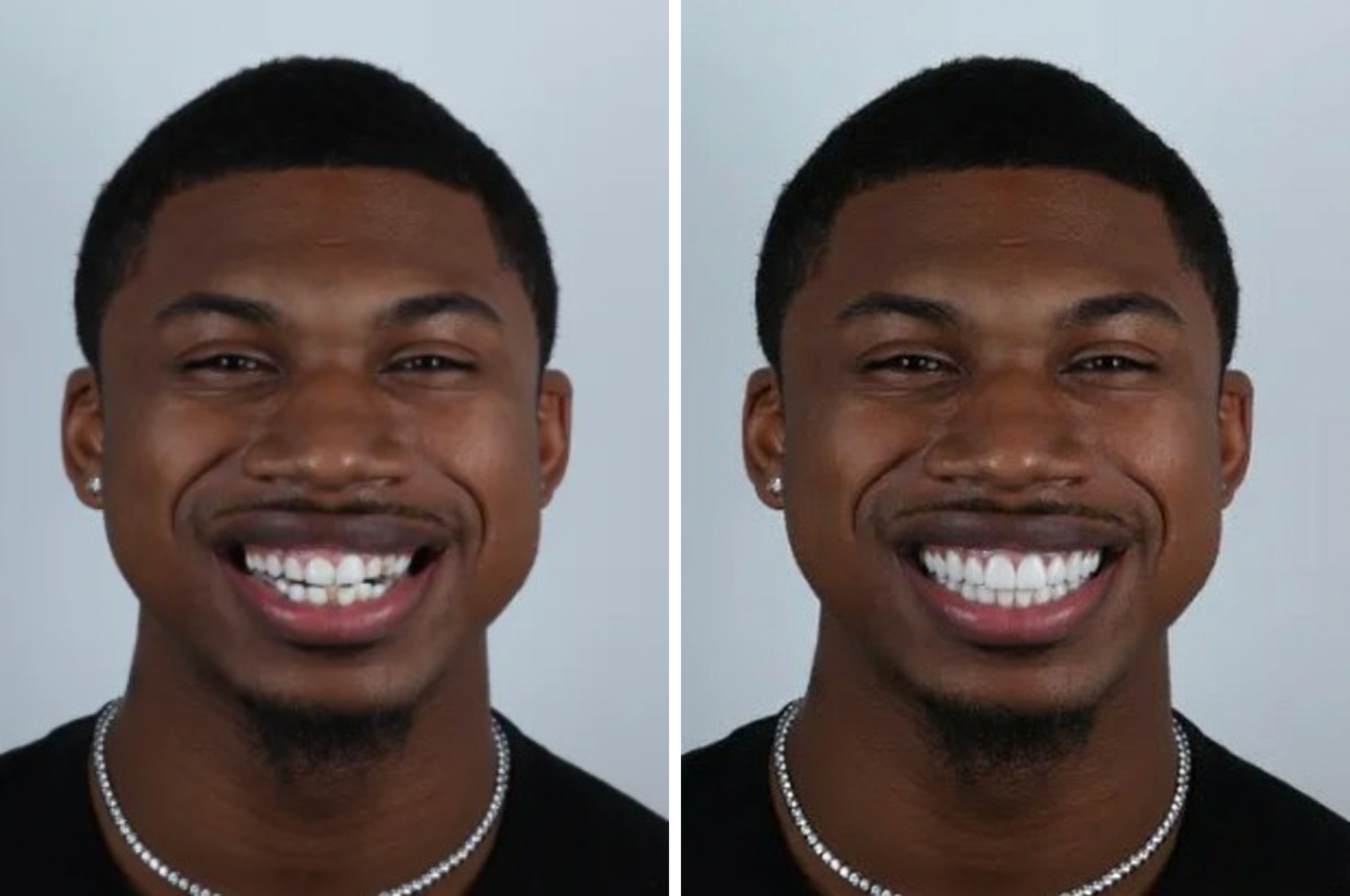 A man before and after with an even brighter smile