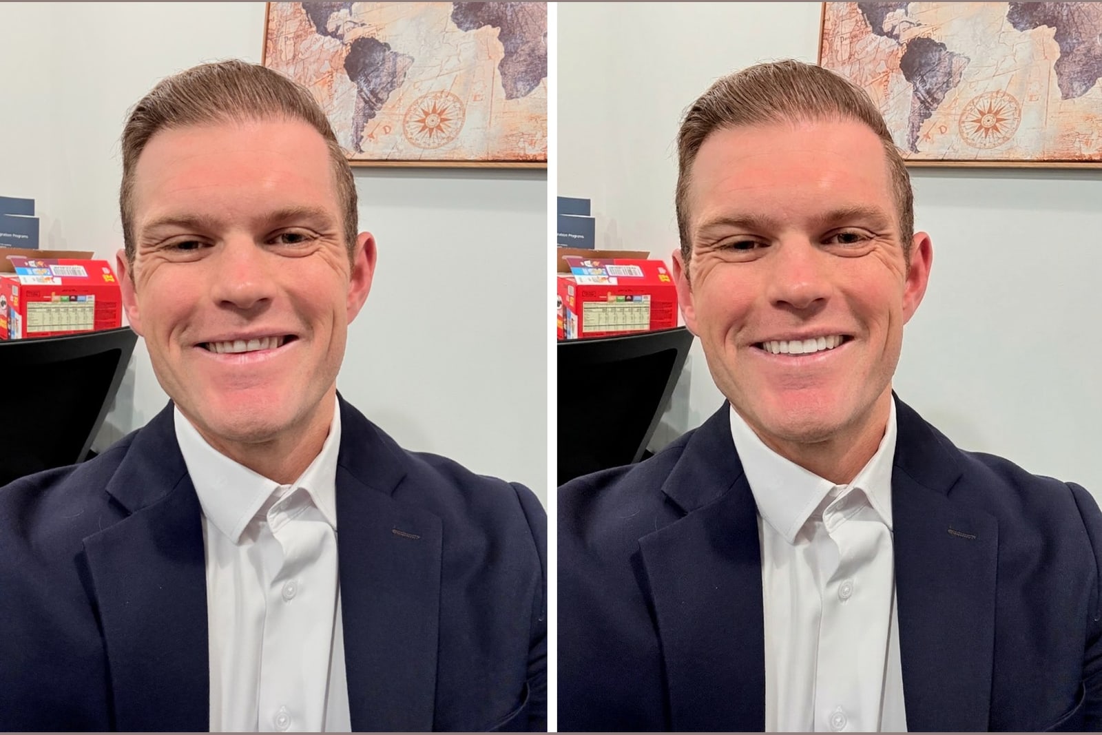 A real smile shown before and after veneers, illustrating no prep veneers