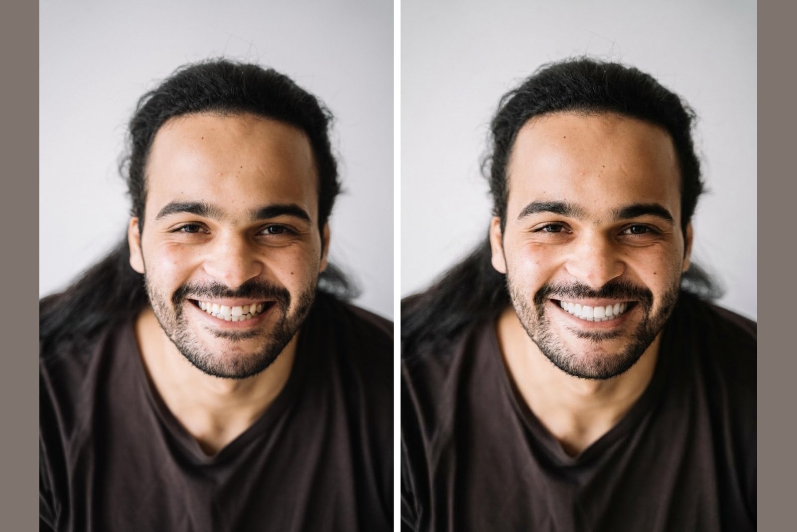 A real smile shown before and after veneers, illustrating veneers vs braces