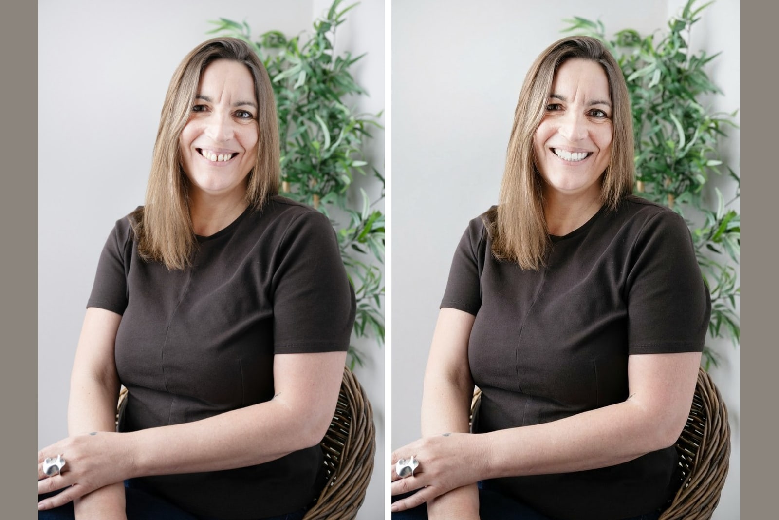 A real smile shown before and after veneers for veneers vs braces