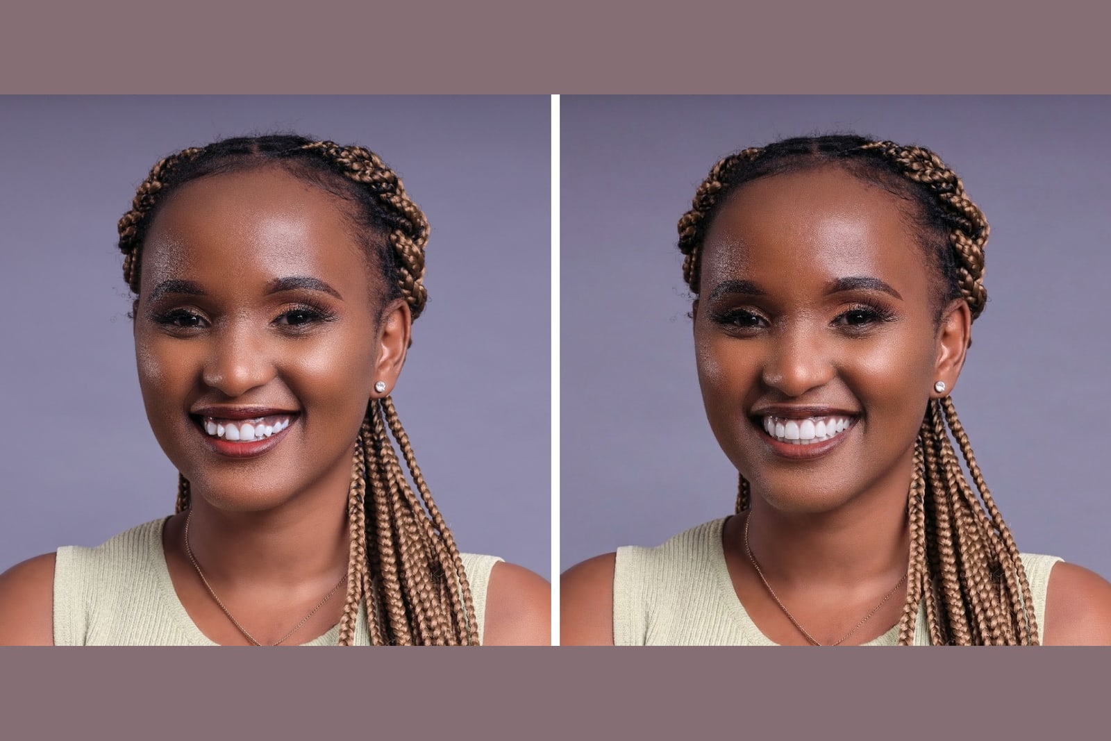 A real smile shown before and after veneers for veneers vs crowns