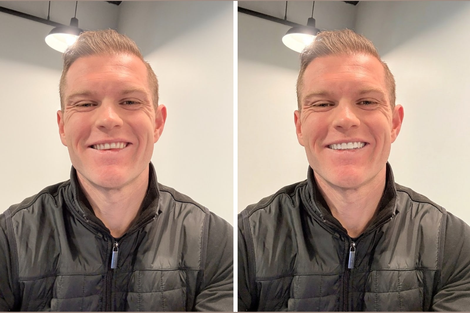 A real smile shown before and after veneers, illustrating veneers vs whitening